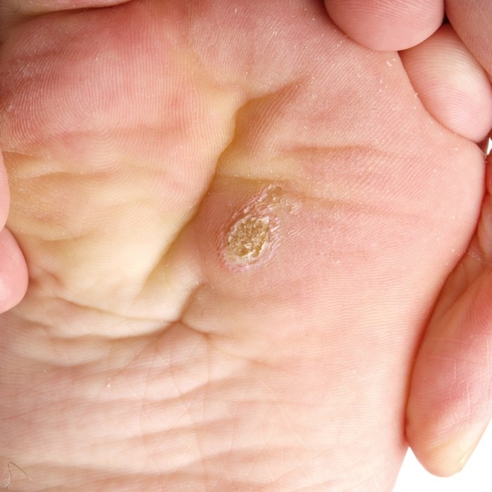 Verruca piede plantar pied warts verrucae wart callo hpv verucca papilloma peau sèche asciutta treatments springhead calus caused callous