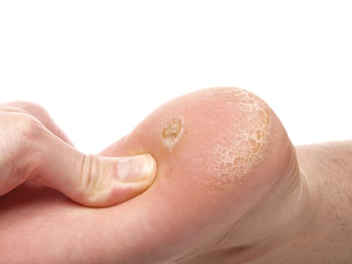 Verruca removal wart treatment medispa level another skin suffering effective safe offers if